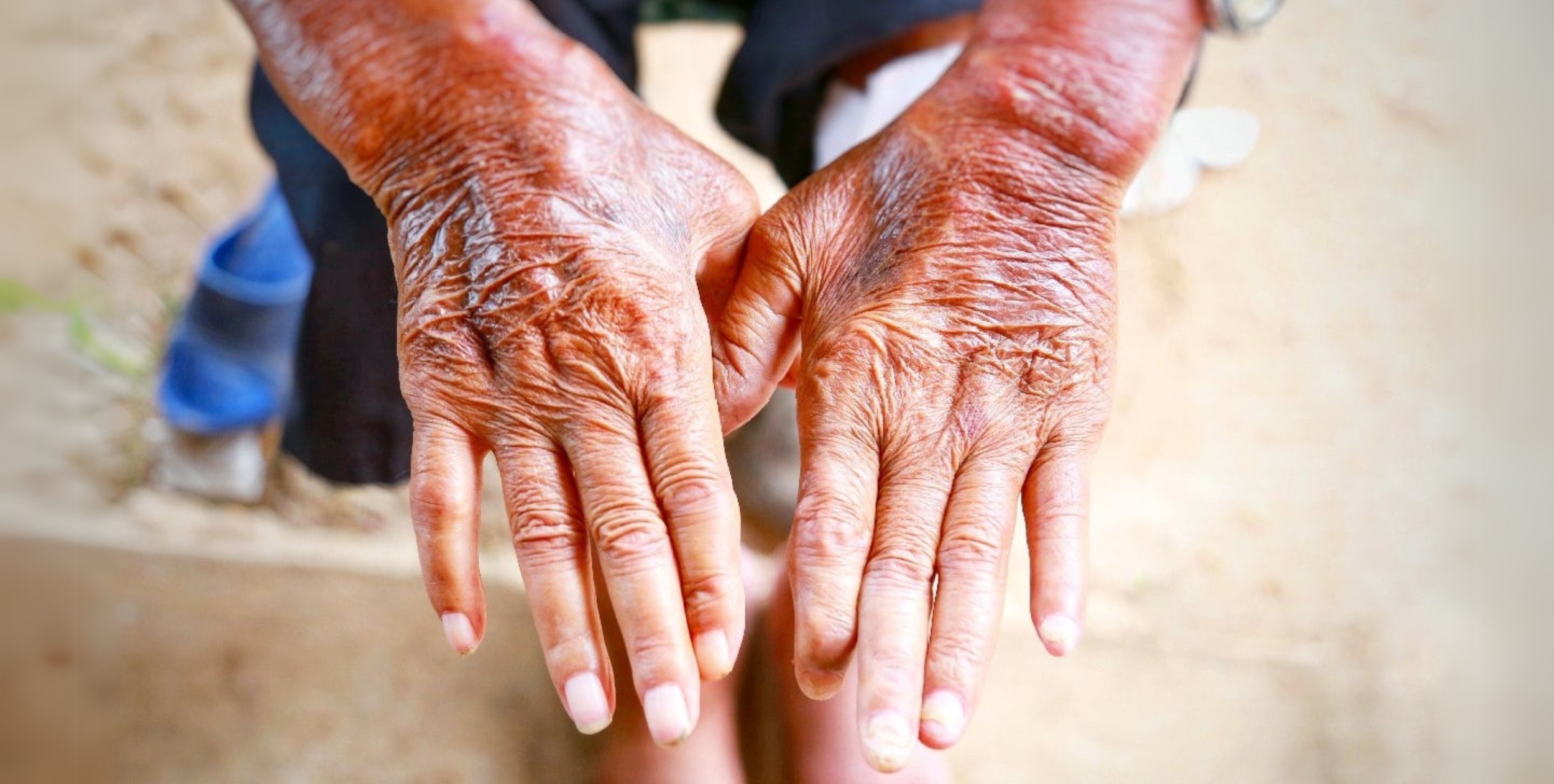 Desi Arthritis Website (7)